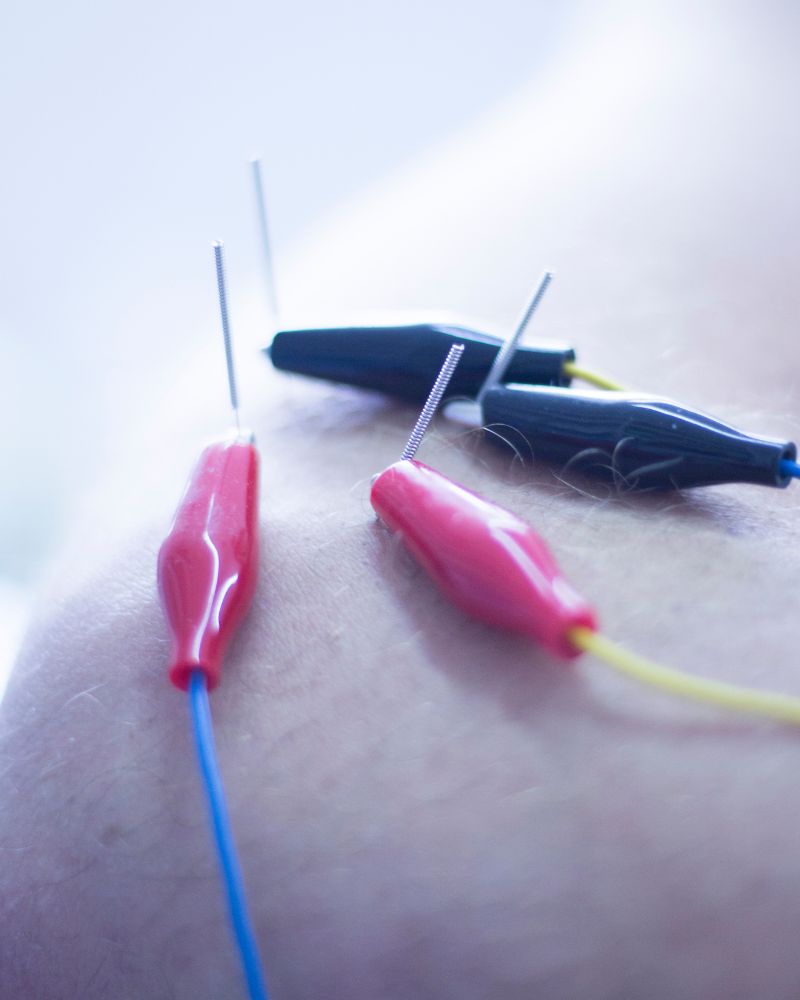 Trigger Point Dry Needling Therapy