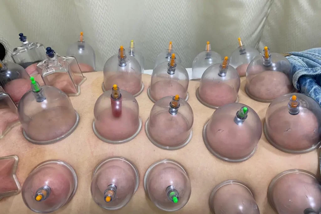 Best Cupping Therapy in Delhi